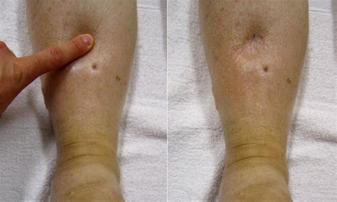 shin compression pitting edema test|pictures of pitting edema.